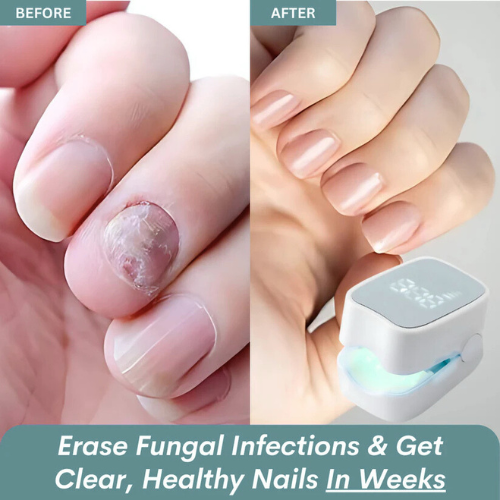 Close-up before and after nail fungus improvement using ClearNail Pro light therapy nail device